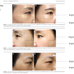 improved wrinkles.1