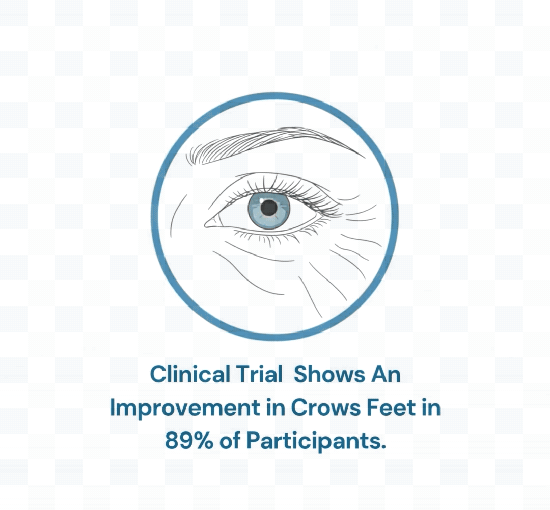 crows feet