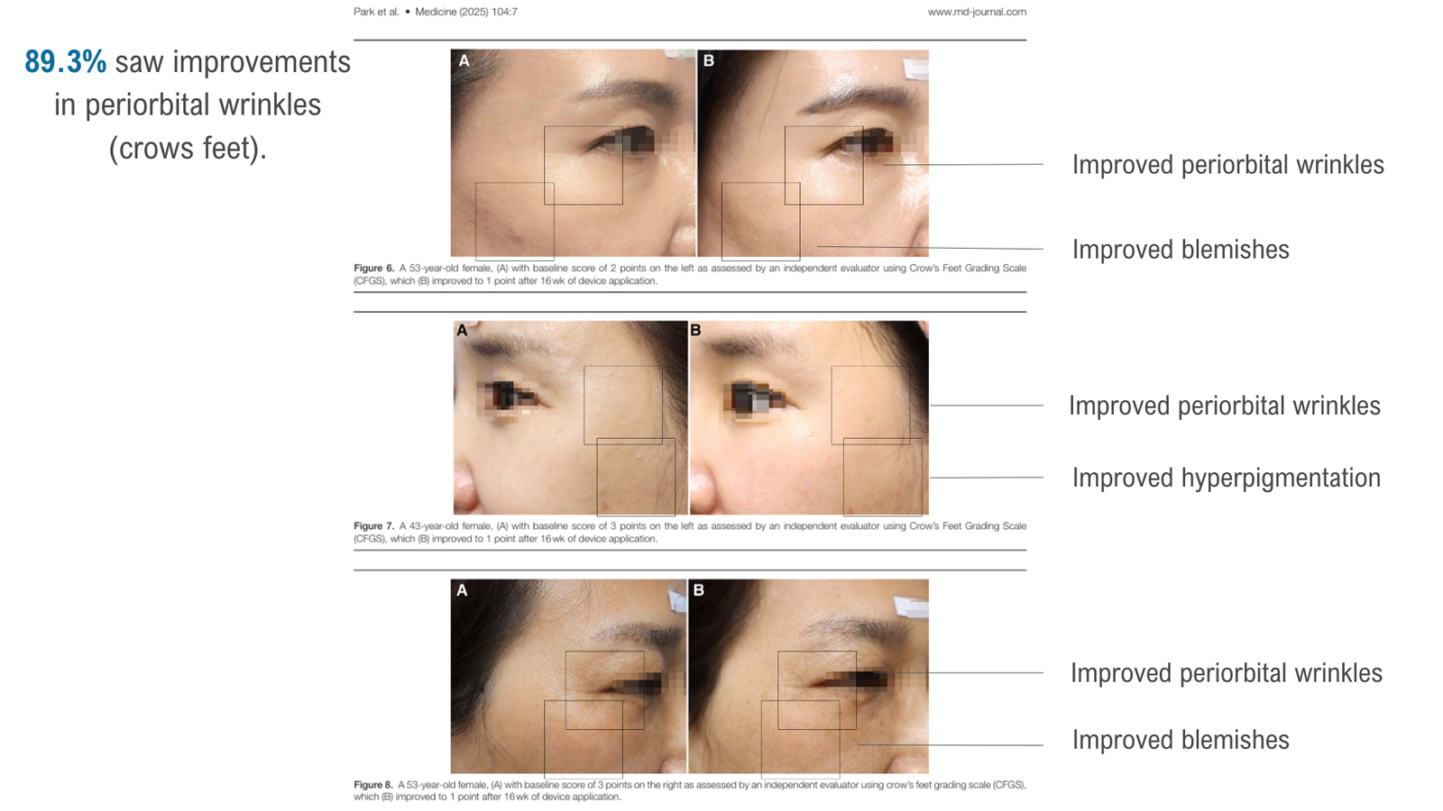 improved wrinkles.1